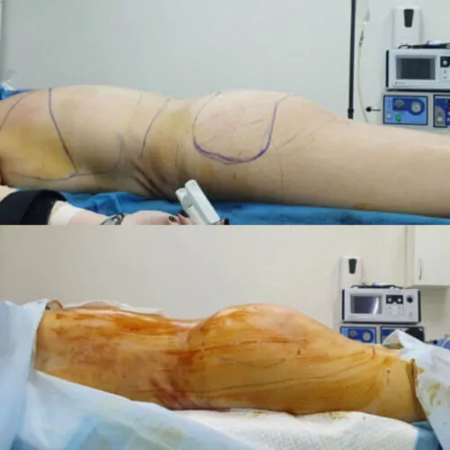 Липофилинг до и после фото 1