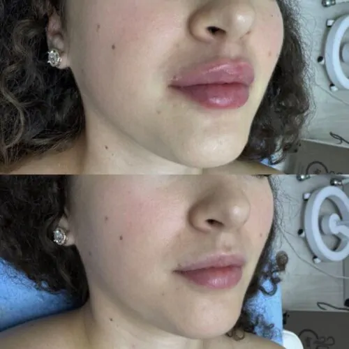 УВЕЛИЧЕНИЕ ГУБ ГИАЛУРОНОВОЙ КИСЛОТОЙ в Киеве от клиники Platinum Laser УВЕЛИЧЕНИЕ ГУБ ГИАЛУРОНОВОЙ КИСЛОТОЙ до и после фото 54