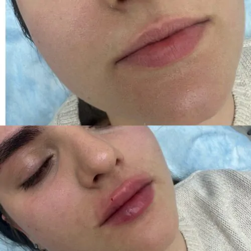 УВЕЛИЧЕНИЕ ГУБ ГИАЛУРОНОВОЙ КИСЛОТОЙ в Киеве от клиники Platinum Laser УВЕЛИЧЕНИЕ ГУБ ГИАЛУРОНОВОЙ КИСЛОТОЙ до и после фото 55