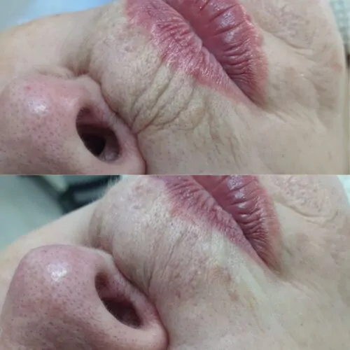 Контурная пластика лица до и после фото 18