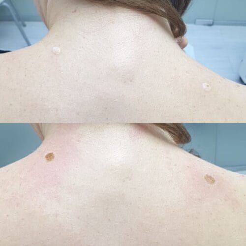 Лазерное удаление новообразований в Киеве от клиники Platinum Laser Лазерное удаление новообразований до и после фото 27