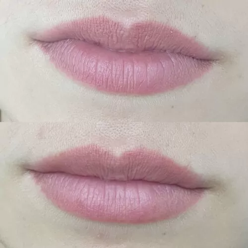 УВЕЛИЧЕНИЕ ГУБ ГИАЛУРОНОВОЙ КИСЛОТОЙ в Киеве от клиники Platinum Laser УВЕЛИЧЕНИЕ ГУБ ГИАЛУРОНОВОЙ КИСЛОТОЙ до и после фото 53