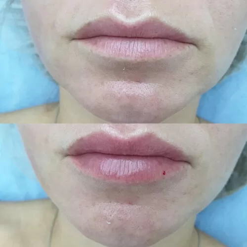 УВЕЛИЧЕНИЕ ГУБ ГИАЛУРОНОВОЙ КИСЛОТОЙ в Киеве от клиники Platinum Laser УВЕЛИЧЕНИЕ ГУБ ГИАЛУРОНОВОЙ КИСЛОТОЙ до и после фото 52