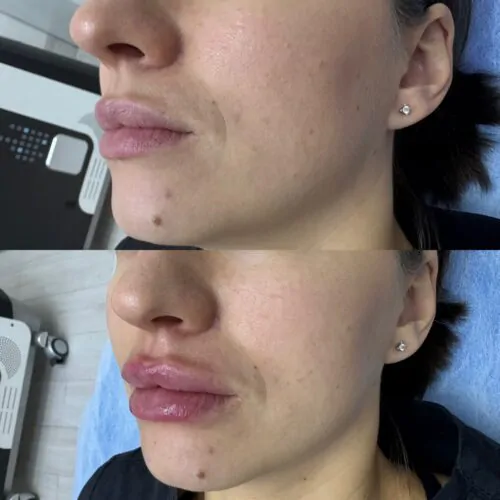 УВЕЛИЧЕНИЕ ГУБ ГИАЛУРОНОВОЙ КИСЛОТОЙ в Киеве от клиники Platinum Laser УВЕЛИЧЕНИЕ ГУБ ГИАЛУРОНОВОЙ КИСЛОТОЙ до и после фото 59