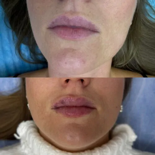 УВЕЛИЧЕНИЕ ГУБ ГИАЛУРОНОВОЙ КИСЛОТОЙ в Киеве от клиники Platinum Laser УВЕЛИЧЕНИЕ ГУБ ГИАЛУРОНОВОЙ КИСЛОТОЙ до и после фото 66