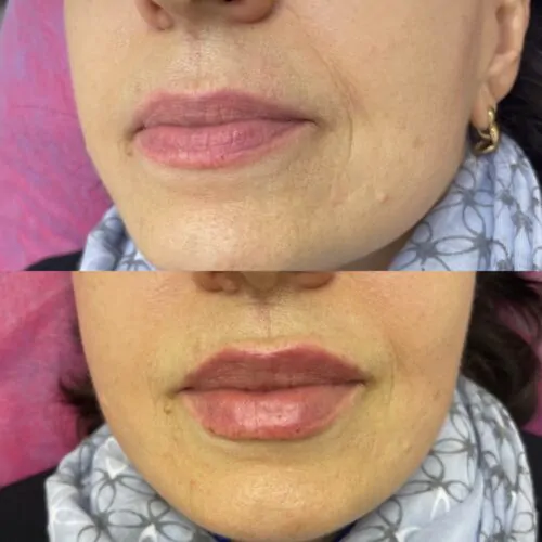 УВЕЛИЧЕНИЕ ГУБ ГИАЛУРОНОВОЙ КИСЛОТОЙ в Киеве от клиники Platinum Laser УВЕЛИЧЕНИЕ ГУБ ГИАЛУРОНОВОЙ КИСЛОТОЙ до и после фото 60