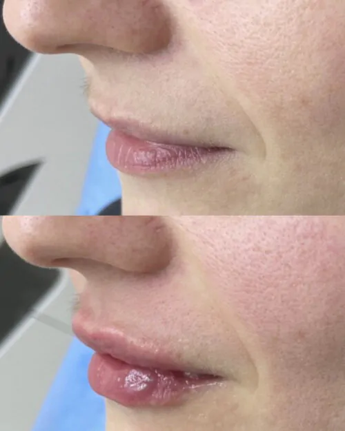 УВЕЛИЧЕНИЕ ГУБ ГИАЛУРОНОВОЙ КИСЛОТОЙ в Киеве от клиники Platinum Laser УВЕЛИЧЕНИЕ ГУБ ГИАЛУРОНОВОЙ КИСЛОТОЙ до и после фото 48