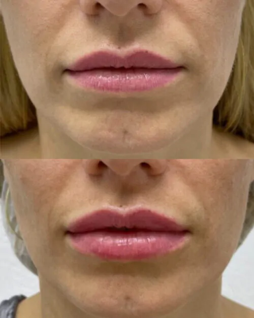 УВЕЛИЧЕНИЕ ГУБ ГИАЛУРОНОВОЙ КИСЛОТОЙ в Киеве от клиники Platinum Laser УВЕЛИЧЕНИЕ ГУБ ГИАЛУРОНОВОЙ КИСЛОТОЙ до и после фото 49