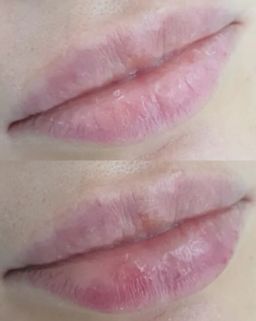 УВЕЛИЧЕНИЕ ГУБ ГИАЛУРОНОВОЙ КИСЛОТОЙ в Киеве от клиники Platinum Laser УВЕЛИЧЕНИЕ ГУБ ГИАЛУРОНОВОЙ КИСЛОТОЙ до и после фото 50