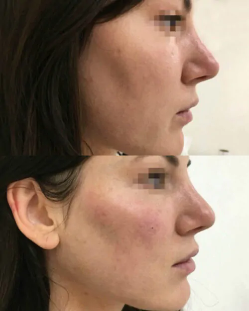 Контурная пластика лица до и после фото 1