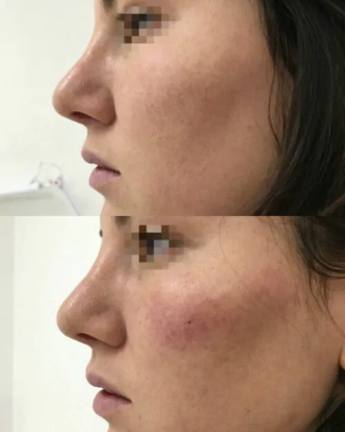 Контурная пластика лица до и после фото 2