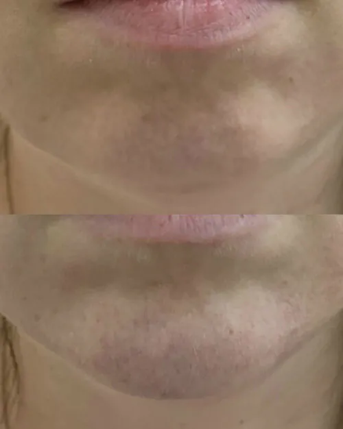 Контурная пластика лица до и после фото 3