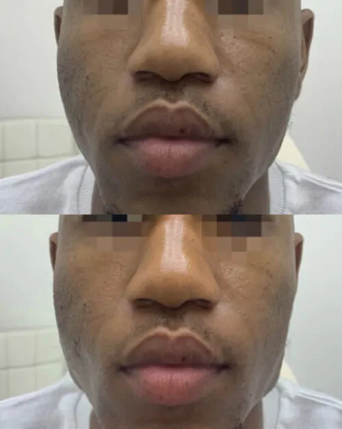 Контурная пластика лица до и после фото 4