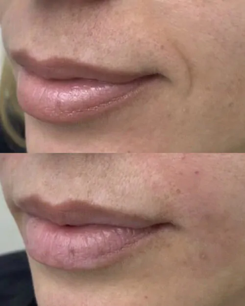 Контурная пластика лица до и после фото 5