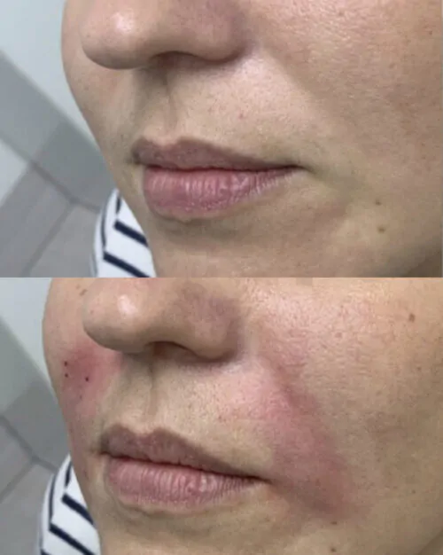 Контурная пластика лица до и после фото 6