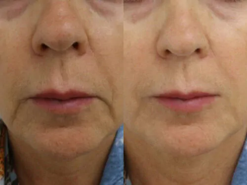 Контурная пластика лица до и после фото 7