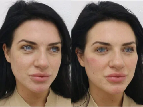 Контурная пластика лица до и после фото 8