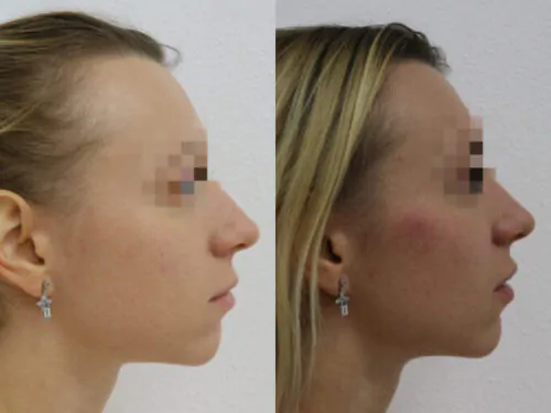 Контурная пластика лица до и после фото 9