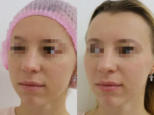 Контурная пластика лица до и после фото 10