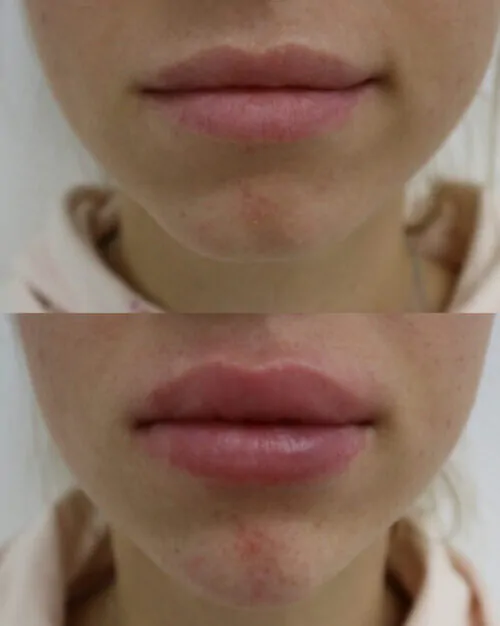 Контурная пластика лица до и после фото 11