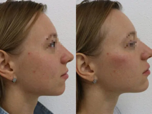 Контурная пластика лица до и после фото 12