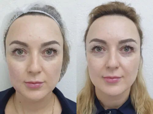 Контурная пластика лица до и после фото 14