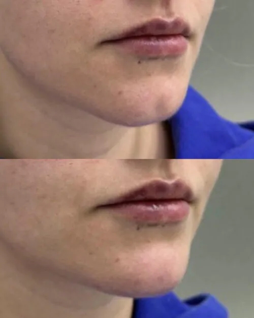 Контурная пластика лица до и после фото 15