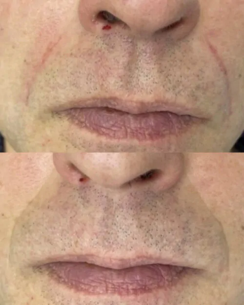 Контурная пластика лица до и после фото 16