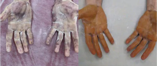 Лечение гипергидроза до и после фото 1