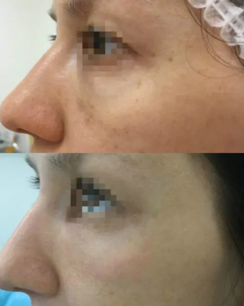 МЕЗОТЕРАПИЯ до и после фото 1