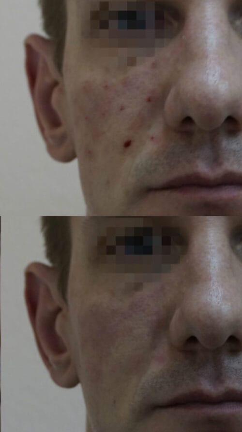 Лазерное удаление новообразований в Киеве от клиники Platinum Laser Лазерное удаление новообразований до и после фото 2