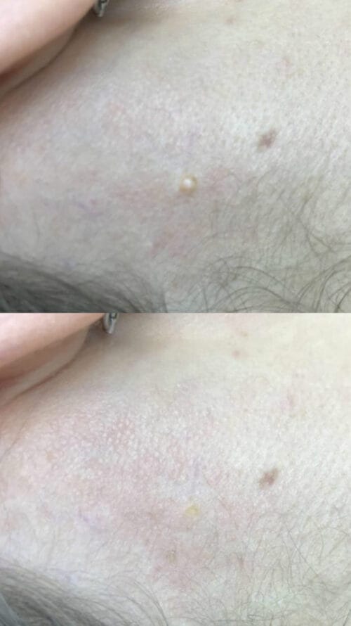 Лазерное удаление новообразований в Киеве от клиники Platinum Laser Лазерное удаление новообразований до и после фото 9