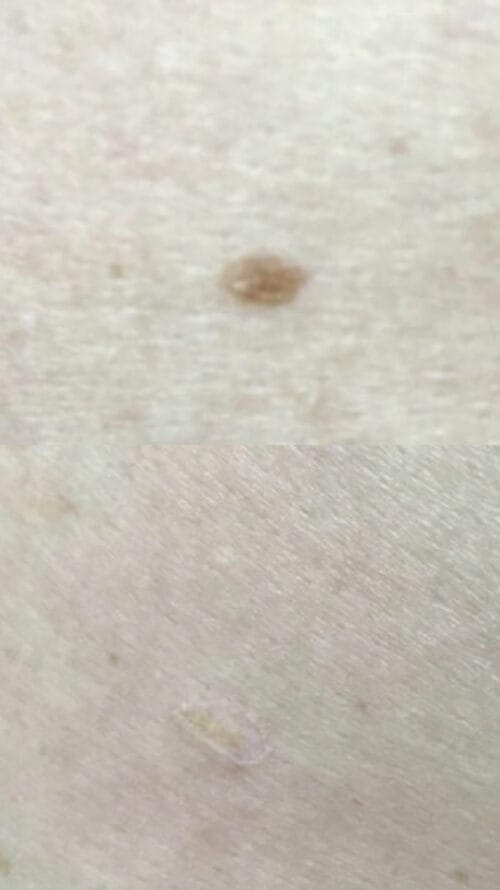 Лазерное удаление новообразований в Киеве от клиники Platinum Laser Лазерное удаление новообразований до и после фото 10