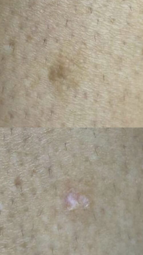 Лазерное удаление новообразований в Киеве от клиники Platinum Laser Лазерное удаление новообразований до и после фото 18