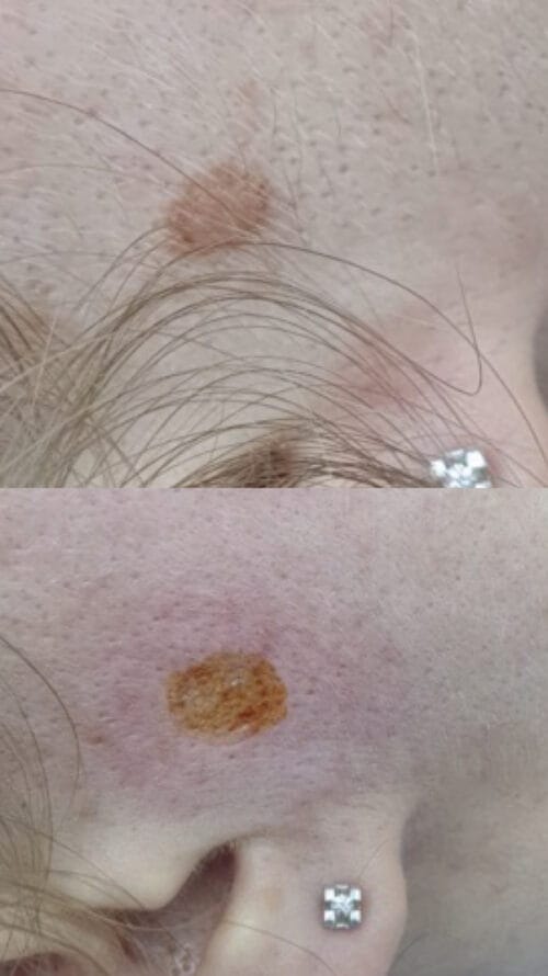 Лазерное удаление новообразований в Киеве от клиники Platinum Laser Лазерное удаление новообразований до и после фото 19