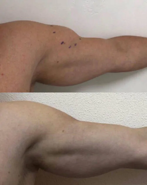 Амбулаторная хирургия в Киеве от клиники Platinum Laser Амбулаторная хирургия до и после фото 1