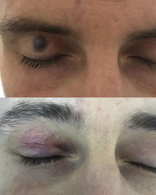 Амбулаторная хирургия в Киеве от клиники Platinum Laser Амбулаторная хирургия до и после фото 2