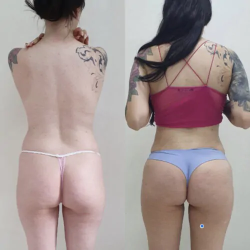 ГЛЮТЕОПЛАСТИКА (ПЛАСТИКА ЯГОДИЦ) до и после фото 1