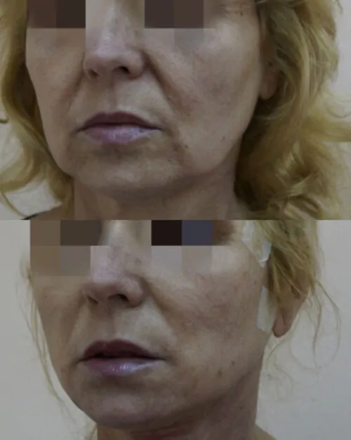 МЕЗОНИТИ до и после фото 1