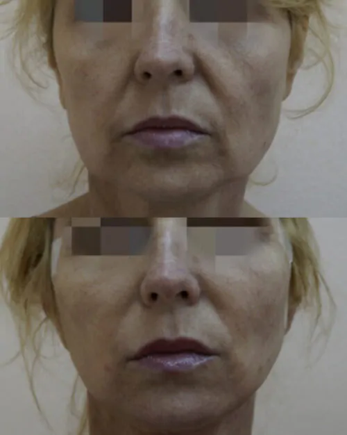 МЕЗОНИТИ до и после фото 2