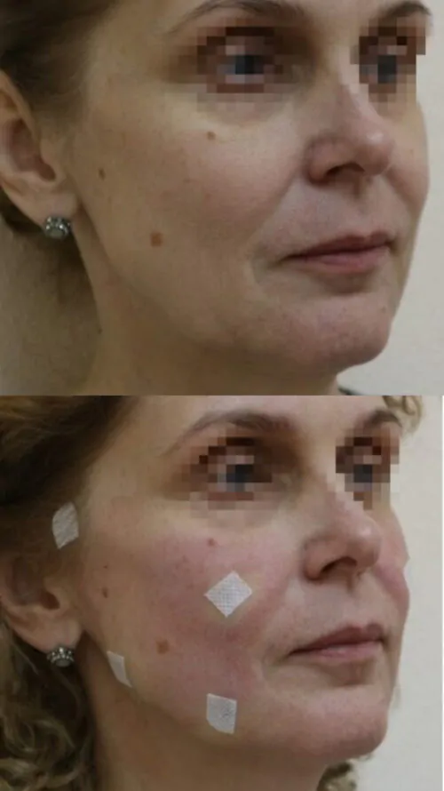 МЕЗОНИТИ до и после фото 3