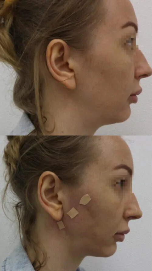 МЕЗОНИТИ до и после фото 4