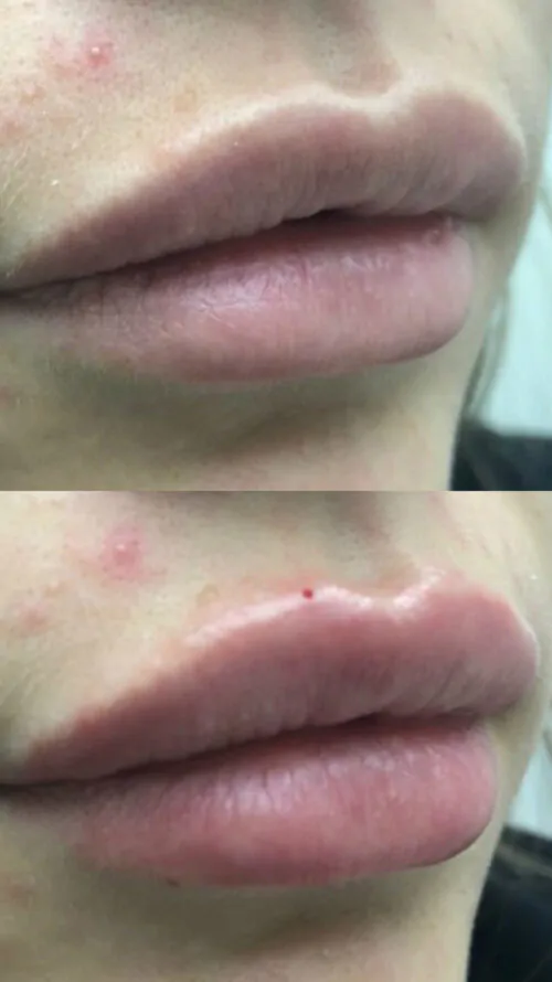 УВЕЛИЧЕНИЕ ГУБ ГИАЛУРОНОВОЙ КИСЛОТОЙ в Киеве от клиники Platinum Laser УВЕЛИЧЕНИЕ ГУБ ГИАЛУРОНОВОЙ КИСЛОТОЙ до и после фото 1