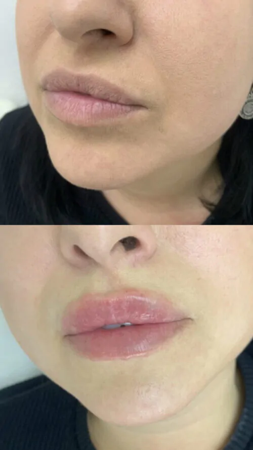 УВЕЛИЧЕНИЕ ГУБ ГИАЛУРОНОВОЙ КИСЛОТОЙ в Киеве от клиники Platinum Laser УВЕЛИЧЕНИЕ ГУБ ГИАЛУРОНОВОЙ КИСЛОТОЙ до и после фото 2