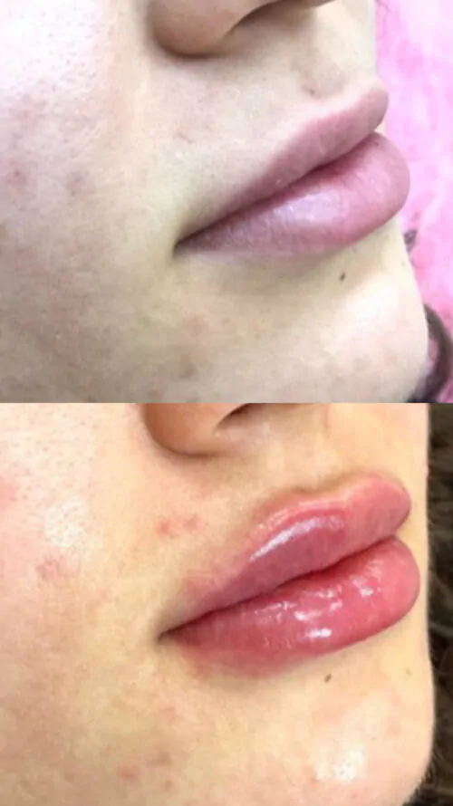 УВЕЛИЧЕНИЕ ГУБ ГИАЛУРОНОВОЙ КИСЛОТОЙ в Киеве от клиники Platinum Laser УВЕЛИЧЕНИЕ ГУБ ГИАЛУРОНОВОЙ КИСЛОТОЙ до и после фото 3