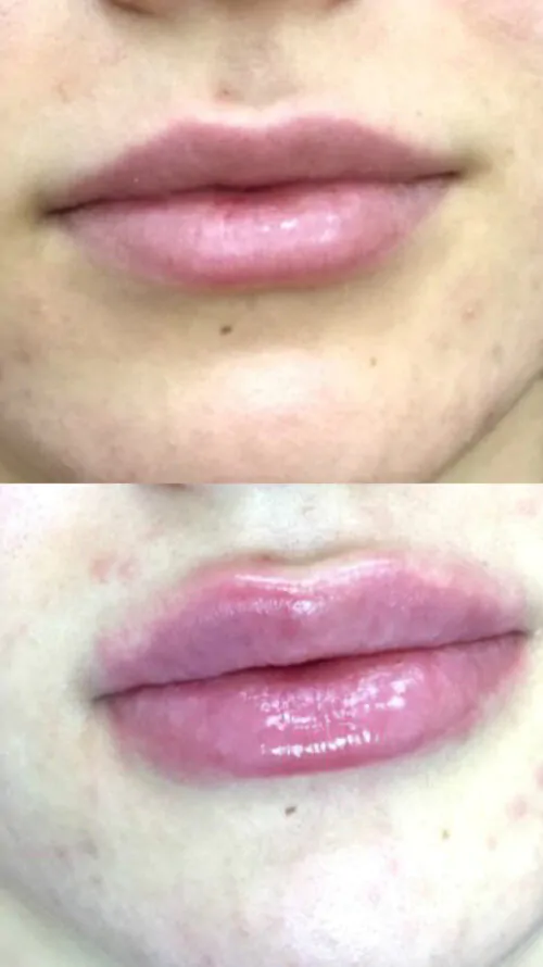 УВЕЛИЧЕНИЕ ГУБ ГИАЛУРОНОВОЙ КИСЛОТОЙ в Киеве от клиники Platinum Laser УВЕЛИЧЕНИЕ ГУБ ГИАЛУРОНОВОЙ КИСЛОТОЙ до и после фото 4