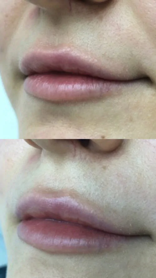 УВЕЛИЧЕНИЕ ГУБ ГИАЛУРОНОВОЙ КИСЛОТОЙ в Киеве от клиники Platinum Laser УВЕЛИЧЕНИЕ ГУБ ГИАЛУРОНОВОЙ КИСЛОТОЙ до и после фото 5