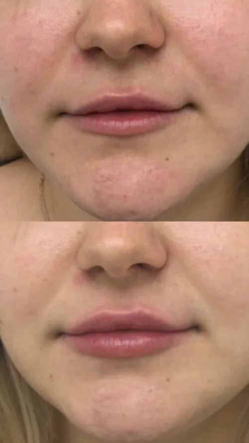 УВЕЛИЧЕНИЕ ГУБ ГИАЛУРОНОВОЙ КИСЛОТОЙ в Киеве от клиники Platinum Laser УВЕЛИЧЕНИЕ ГУБ ГИАЛУРОНОВОЙ КИСЛОТОЙ до и после фото 6