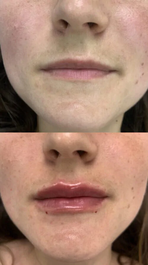 УВЕЛИЧЕНИЕ ГУБ ГИАЛУРОНОВОЙ КИСЛОТОЙ в Киеве от клиники Platinum Laser УВЕЛИЧЕНИЕ ГУБ ГИАЛУРОНОВОЙ КИСЛОТОЙ до и после фото 8