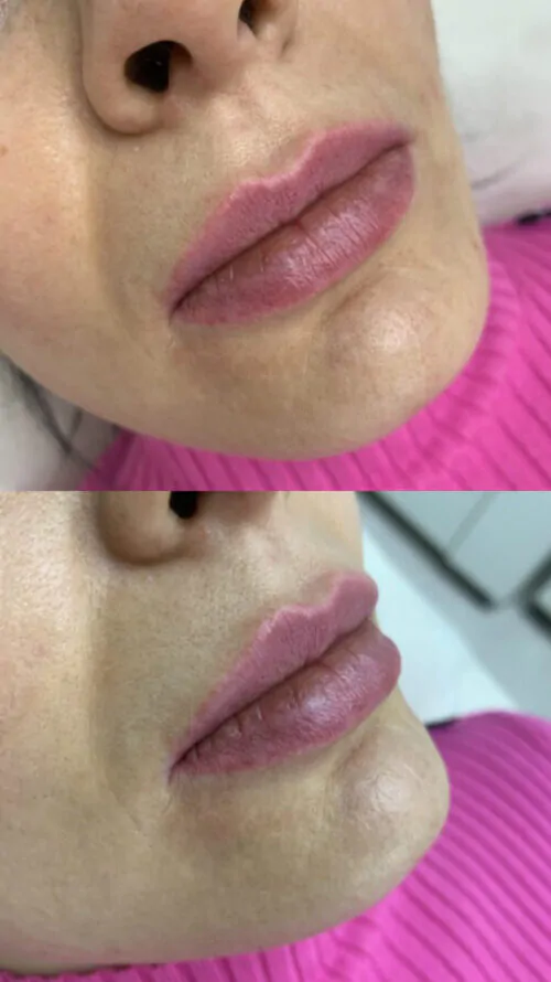 УВЕЛИЧЕНИЕ ГУБ ГИАЛУРОНОВОЙ КИСЛОТОЙ в Киеве от клиники Platinum Laser УВЕЛИЧЕНИЕ ГУБ ГИАЛУРОНОВОЙ КИСЛОТОЙ до и после фото 9